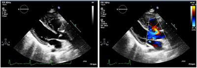 Perioperative Management of Subarachnoid Hemorrhage in a Patient with Alagille Syndrome and Unrepaired Tetralogy of Fallot: Case Report